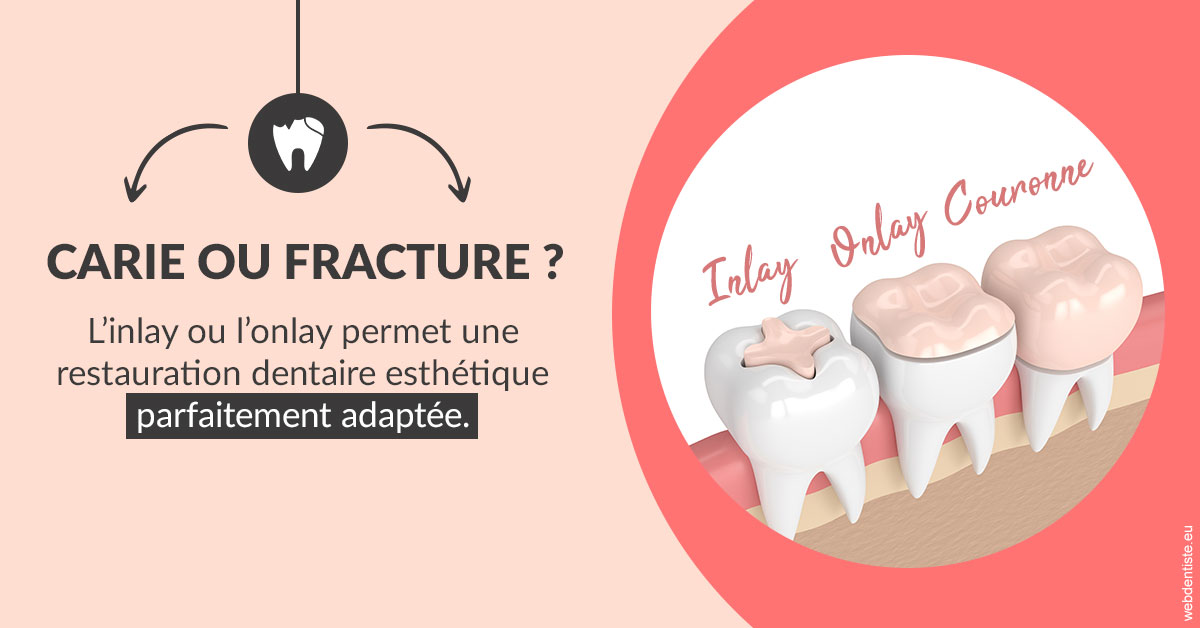 https://www.dentistes-haut-lac.ch/T2 2023 - Carie ou fracture 2