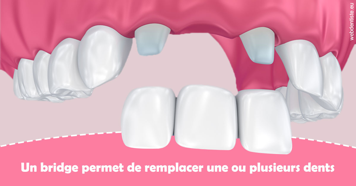 https://www.dentistes-haut-lac.ch/Bridge remplacer dents 2