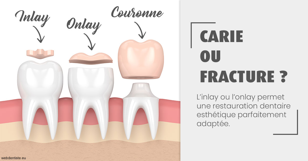 https://www.dentistes-haut-lac.ch/T2 2023 - Carie ou fracture 1