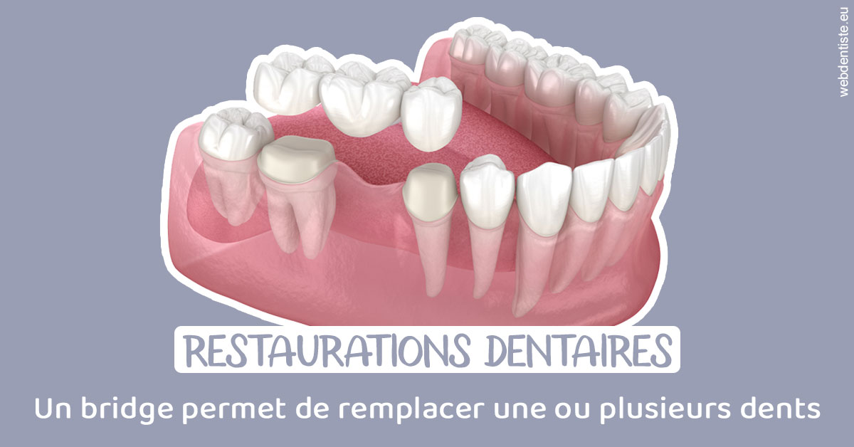 https://www.dentistes-haut-lac.ch/Bridge remplacer dents 1