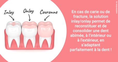 https://www.dentistes-haut-lac.ch/L'INLAY ou l'ONLAY 2