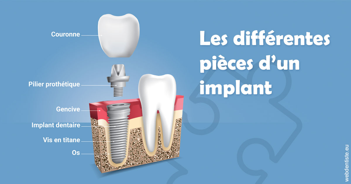https://www.dentistes-haut-lac.ch/Les différentes pièces d’un implant 1