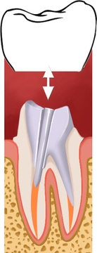 prothèse dentaire 2_4
